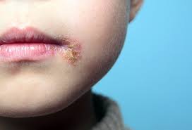 Use condoms or dental dams. How Easy Is It To Get Herpes