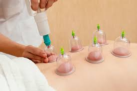 Hijama Treatment in Abu Dhabi | Cupping Therapy Services