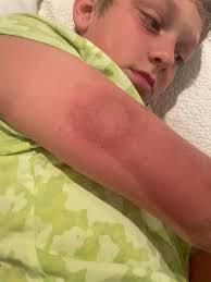 My son is 4, we found this rash