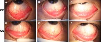 It was first identified in december 2019 in wuhan,. Ocular Manifestations Of A Hospitalised Patient With Confirmed 2019 Novel Coronavirus Disease British Journal Of Ophthalmology
