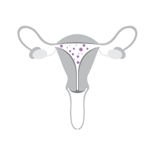 Womb cancers are also called uterine or endometrial cancer. Uterine Endometrial Foundation For Women S Cancer