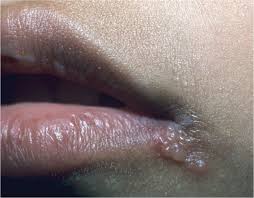 The early stages of herpes are. Nongenital Herpes Simplex Virus American Family Physician