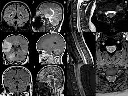 Risk factors associated with acute respiratory distress syndrome and death in patients with coronavirus disease 2019 pneumonia in wuhan, china. Frontiers Relapsing Demyelinating Syndromes In Children A Practical Review Of Neuroradiological Mimics Neurology