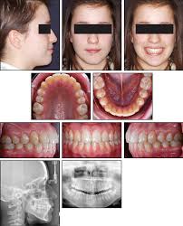 The postoperative recovery was longer after open eruption than close eruption technique (p = 0.000). Case Report Jco Online Journal Of Clinical Orthodontics