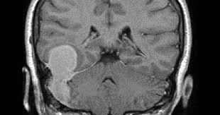 Pin On Gamma Knife