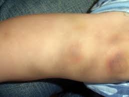 Idiopathic thrombocytopenic purpura (itp) is a bleeding condition in which the blood doesn't clot as it should. Bleeding And Bruising Dermnet Nz