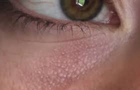 The problem of milia is common among babies tiny hard pimples will develop on the face as a result of trapped skin debris. Under Eye Bumps Not Milia Beauty Insider Community