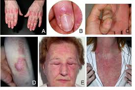 Figure 1 from The clinical features, diagnosis and classification of  dermatomyositis.