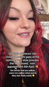 braceson #braceupdate #fypシ゚viral