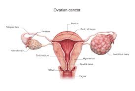Ovarian Cancer Causes Signs And Symptoms And Diagnosis Jwci
