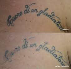 Chest Tattoo After 1 Session Lasertattooremoval Tattooremovaltoronto Tattoo Howtoremoveatattoo Tattoo Quotes Tattoos Tattoo Removal