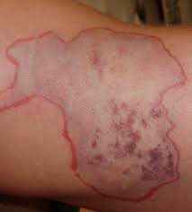 The brown recluse spider is one of the most dangerous spiders living here in the us. Lesion Of A Brown Recluse Spider Bite Download Scientific Diagram