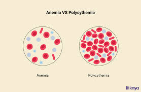 Image result for Anemia