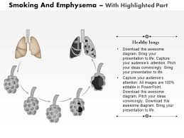 0614 Smoking And Emphysema Medical Images For Powerpoint
