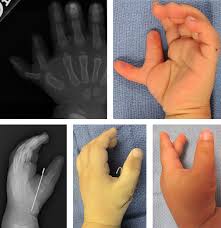 Reconstructive surgery is the main treatment. Congenital Hand Differences A Review Iranian Journal Of Pediatrics Full Text