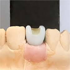 Do not use phosphoric acid for cleaning. The Influence Of Two Different Cements On Remaining Cement Excess In Cement Retained Implant Supported Zirconia Crowns An In Vitro Study Bdj Open