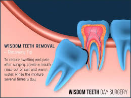 It can be directly applied to the aching tooth. Impacted Wisdom Teeth Removal Cost Ontario Teethwalls