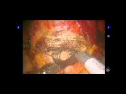Pin On Cancer Surgery
