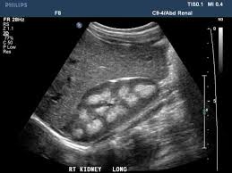 Abnormal Kidney Medical Ultrasound Ultrasound Diagnostic Medical Sonography
