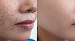 What Is Acne Pigmentation? Causes and Solutions – Garnier India