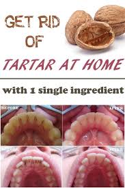 The thick, filmy nature of plaque and tartar this condition is caused by a disruption in development which causes enamel to be hard but thin. Get Rid Of The Tartar With A Single Ingredient At Home Beauty Tricks Hollistic Health Health Remedies Natural Remedies