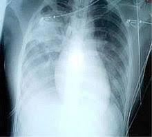 We did not find results for: Pneumonia Wikipedia