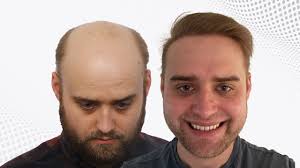 Hair transplantation is a verified surgical procedure