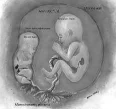 Management Of Twin To Twin Transfusion Syndrome Adc Fetal Neonatal Edition