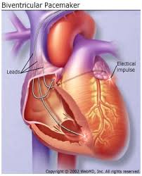 Biventricular Pacing To Treat Heart Failure