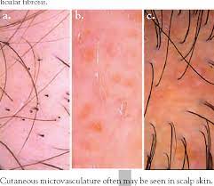 If the clogged pore is open and exposed to the air, the spot will turn black. Figure 2 From Trichoscopy A New Method For Diagnosing Hair Loss Semantic Scholar