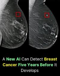 A Revolutionary Step Forward: The New Breast Cancer Scanner That’s ...