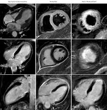 Khk, ischämietest bei bekannter khk). Https Www Thieme Connect De Products Ejournals Pdf 10 1055 S 0042 102041 Pdf