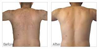 Invest in a permanent hair removal nh pair of tweezers so you have a clean, sharp pair each time. Laser Hair Removal Naperville Plainfield Bolingbrook Affordable Laser Hair Removal Near Me