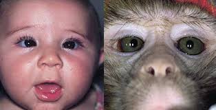 Marshall Parks Lecture Can Ophthalmologists Repair the Brain in Infantile  Esotropia? Early Surgery, Stereopsis, Monofixation Syn