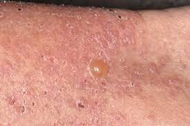 Bullous Pemphigoid Nhs