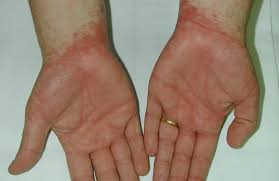 Image result for dermatitis contacta