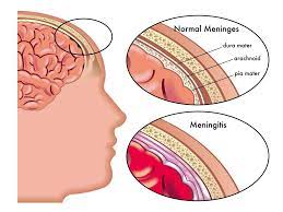 Melancarkan peredaran darah dalam tubuh. Jangkitan Selaput Otak Meningitis Dr Zubaidi Hj Ahmad Facebook