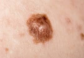 Melanoma When Should You Worry About A Mole Health