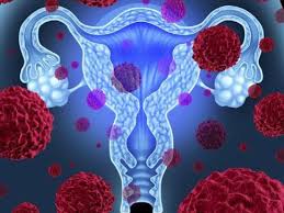 Este video habla sobre la importancia de conocer los signos y síntomas del cáncer ginecológico. Dia Contra El Cancer De Cuello Uterino Las Causas Y Sintomas De Este Peligroso Mal Tecnologia El Comercio Peru