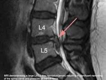 Image result for what is the treatment for l 5 l 5