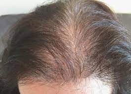 Chez certaines femmes, la perte de cheveux peut être causée par une attaque du système immunitaire sur les follicules pileux provoquant un type de perte de cheveux inégale appelée alopecia areata. Agencia Dos Correios Segredo Encontro Perte Densite Cheveux Femme Mamaindeval Com
