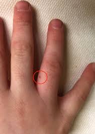 Image result for spinne biss haut reaktion