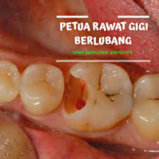 Gigit 3 kuntum bunga cengkih pada tempat yang sakit. Petua Rawat Gigi Berlubang Pengedar Shaklee Sah Malaysia