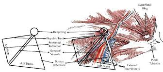 It is a 'v' shaped defect in the external oblique aponeurosis, whose apex is parallel with the deep aponeurotic fibres. Hernia Inguinal Hernia Epomedicine