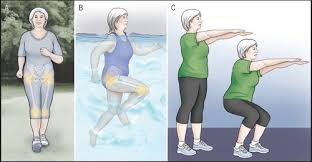 Image result for Exercise in Patients with Arthritis