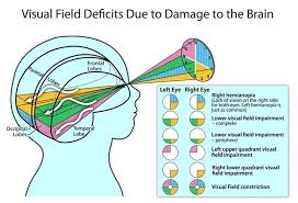 Image result for Visual Field Deficit