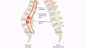 Lumbar Radiculopathy Physiopedia