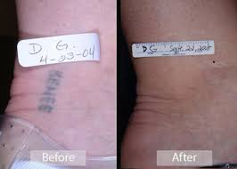 The body then absorbs these ink fragments and naturally eliminates them. Tattoo Removal Sacramento Ca Emil A Tanghetti Md