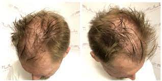 It's easy to treating hair loss: See How Smp Transforms Thinning Hair Into A Full Head Full Micropigmentation