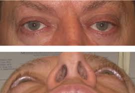 Image result for Proptosis